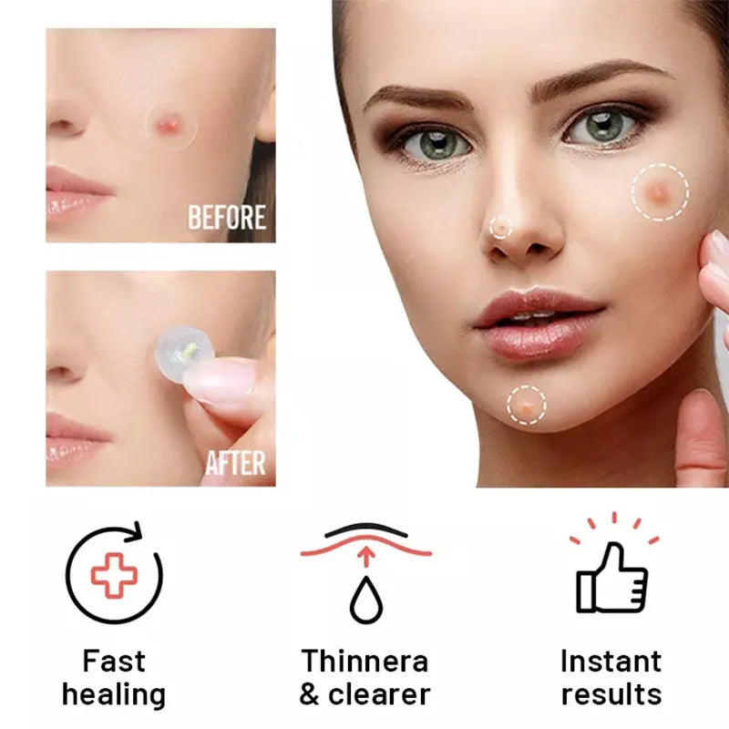 Chin Acne Day & Night Repair Patch for Fast Healing