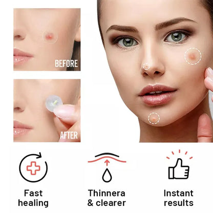 Chin Acne Day &amp; Night Repair Patch for Fast Healing